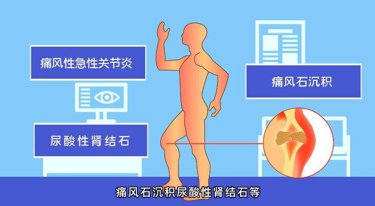 痛风降尿酸别忘了限糖